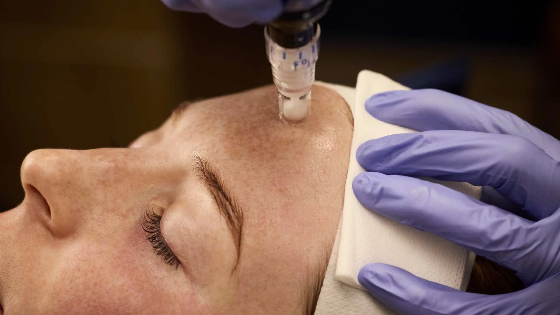 Microneedling Mikrokanäle SkinPen Behandlung