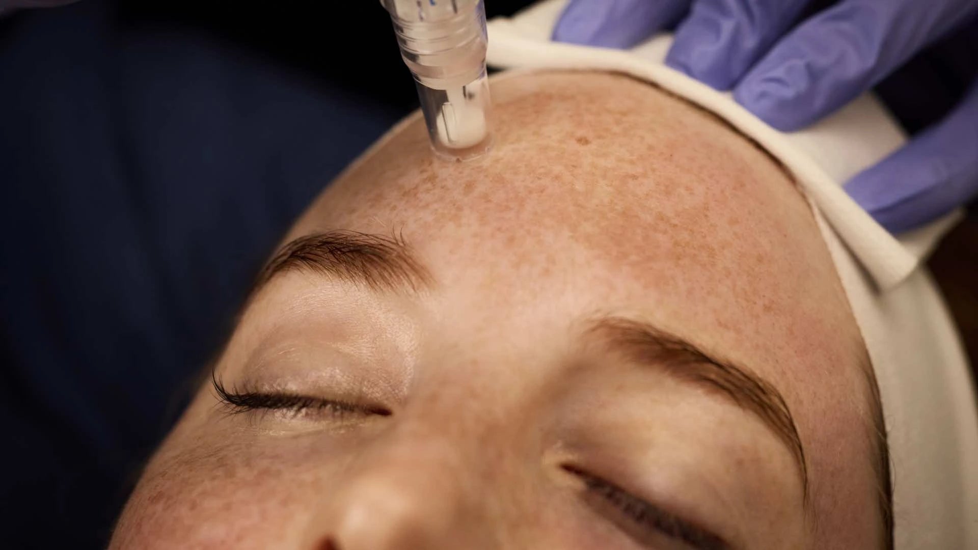 Kollagenaufbau Microneedling Hautstruktur Verbesserung