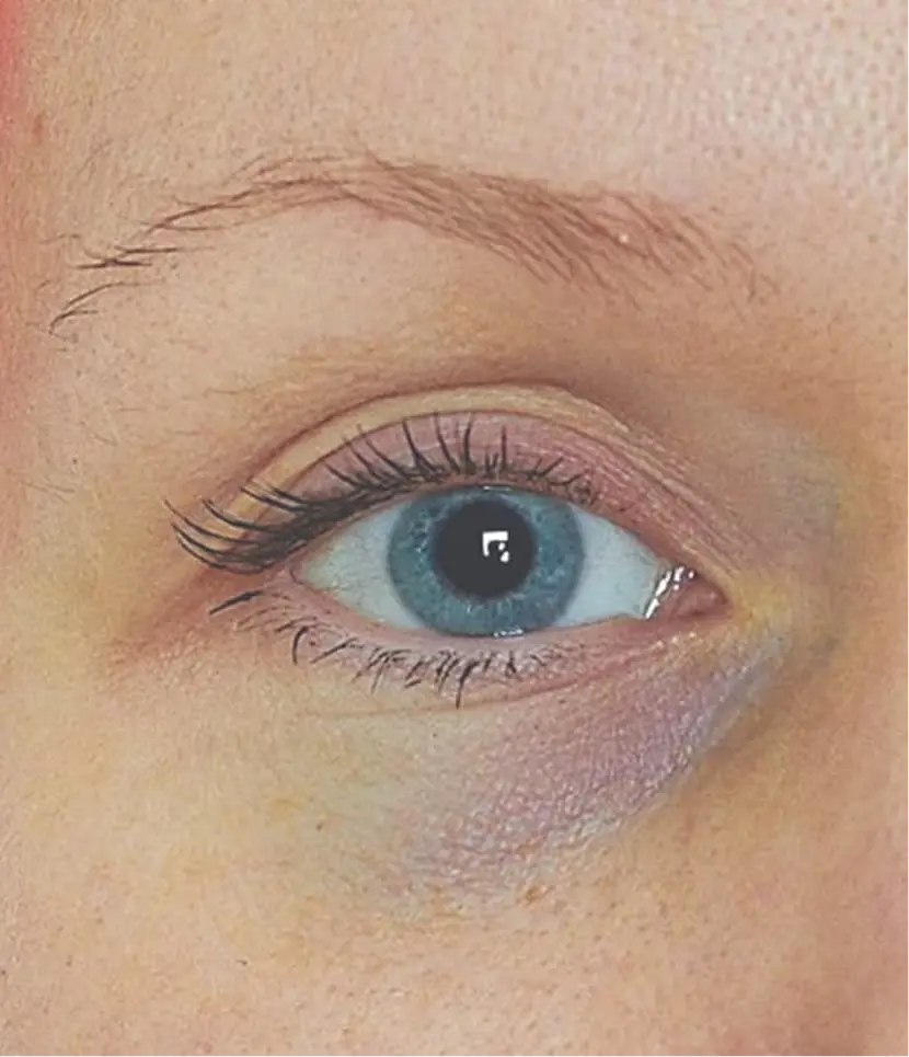 MESOEYE C71 Vorher