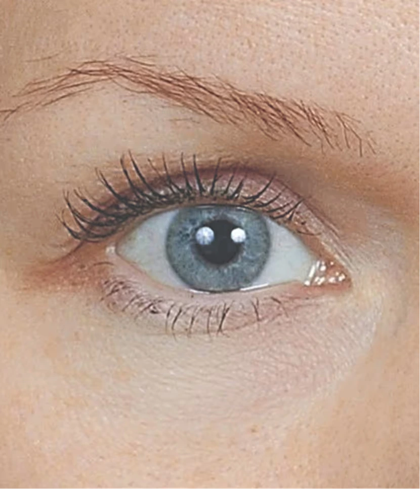 MesoEye C71® nach der Behandlung