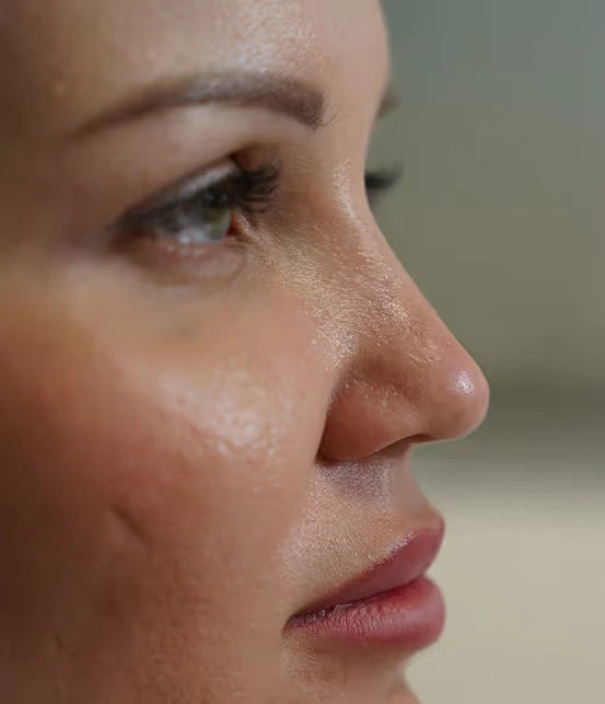 MesoSculpt C71® nach der Behandlung